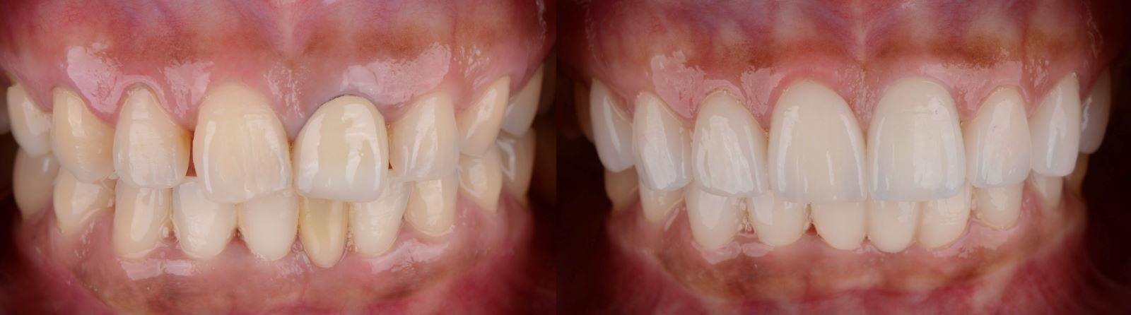 dentist-veneers